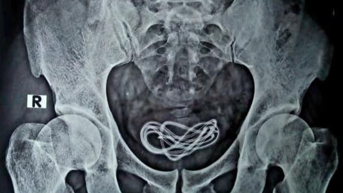 Having A Strange Fetish, Doctors Are Forced To Remove Charger Cable From Male Bladder In India